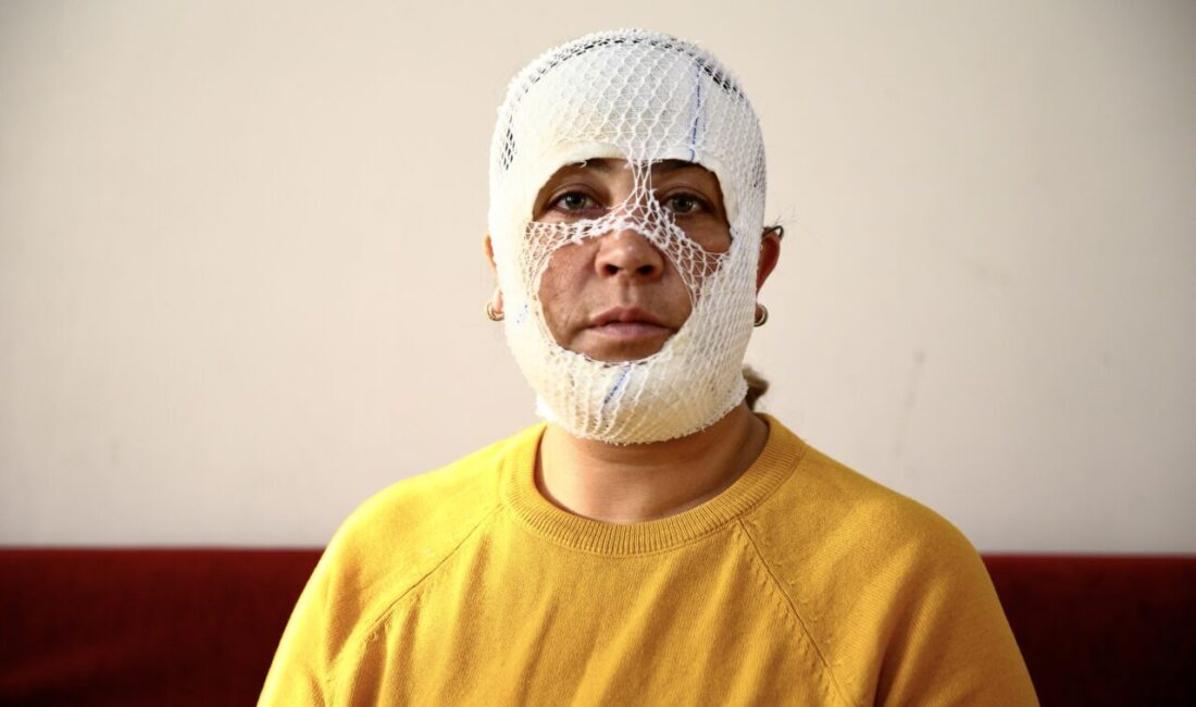 ADANA (AA) – Adana'da güzellik merkezinde yaptırdığı cilt bakımı sonrası