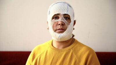 ADANA (AA) – Adana'da güzellik merkezinde yaptırdığı cilt bakımı sonrası