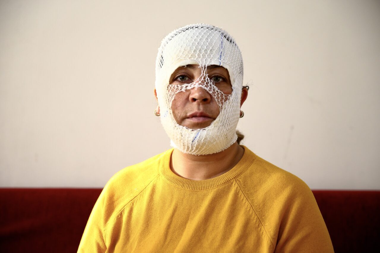 ADANA (AA) – Adana'da güzellik merkezinde yaptırdığı cilt bakımı sonrası