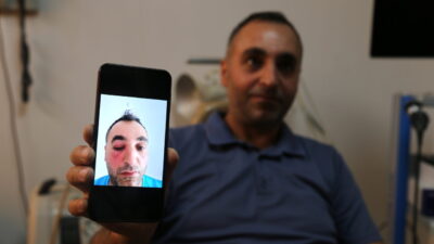 BİTLİS (AA) – Bitlis'te gözyaşı kanalı tıkanıklığı bulunan 44 yaşındaki