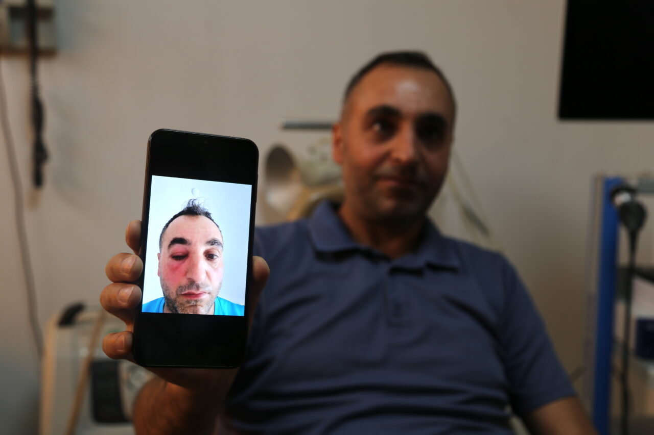 BİTLİS (AA) – Bitlis'te gözyaşı kanalı tıkanıklığı bulunan 44 yaşındaki